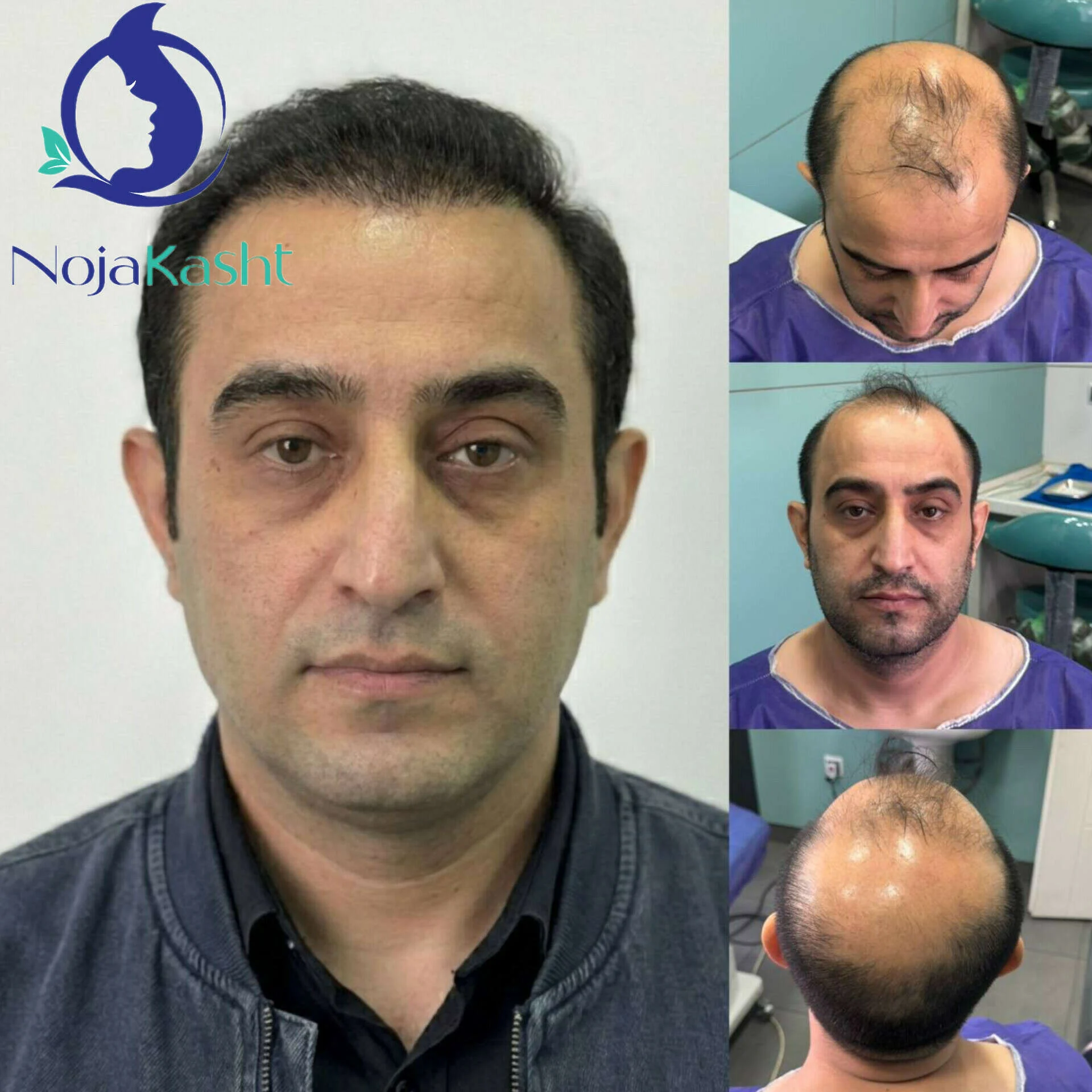 نمونه های کاشت مو در نوژا کاشت - نمای جلوی سر