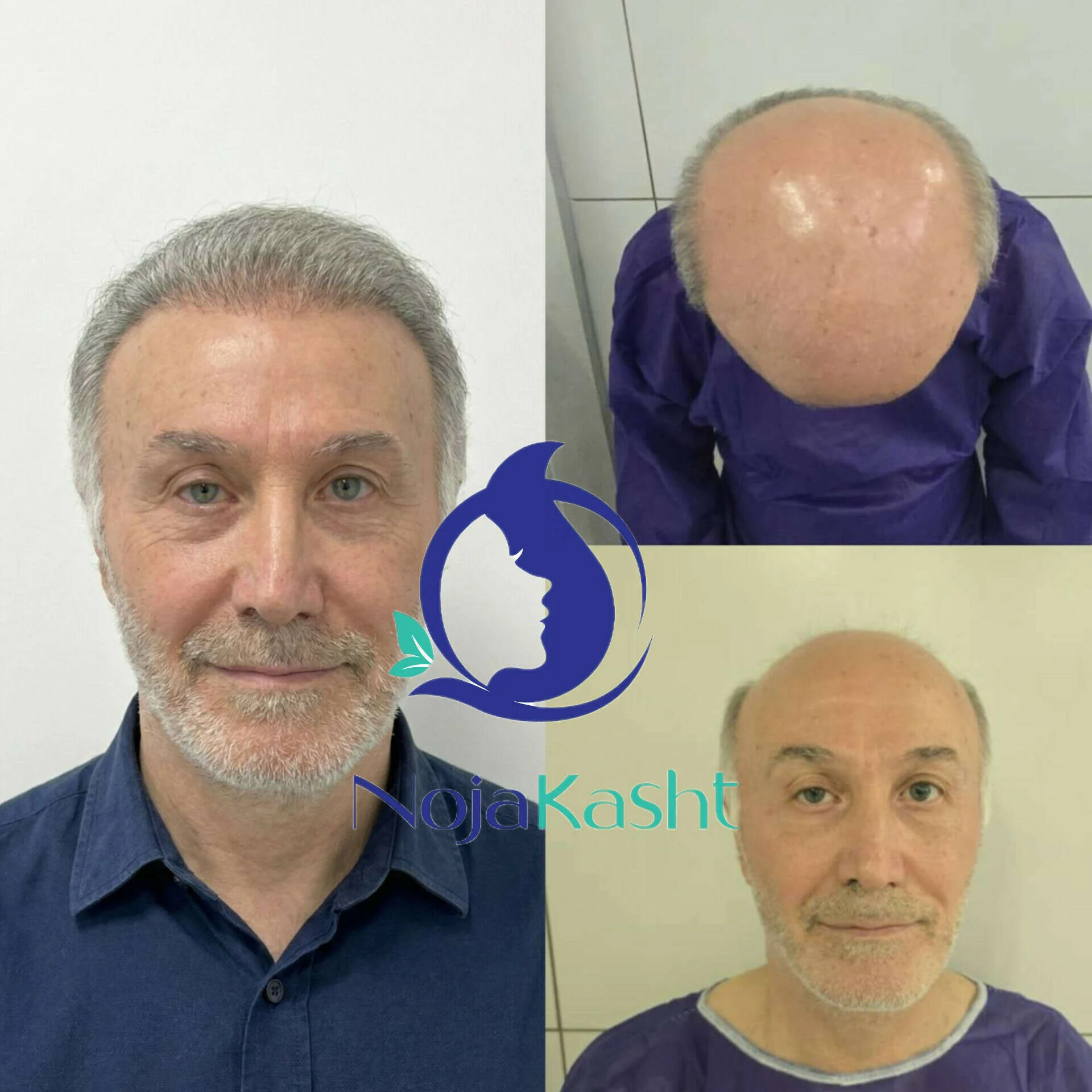 نتیجه کاشت مو در کلینیک نوژا کاشت بعد از ۶ ماه